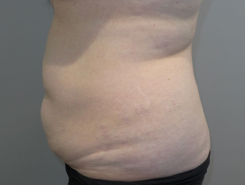 Tummy Tuck Before and After 14 | Sanjay Grover MD FACS