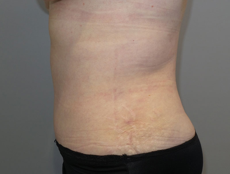 Tummy Tuck Before and After 14 | Grover Aesthetics