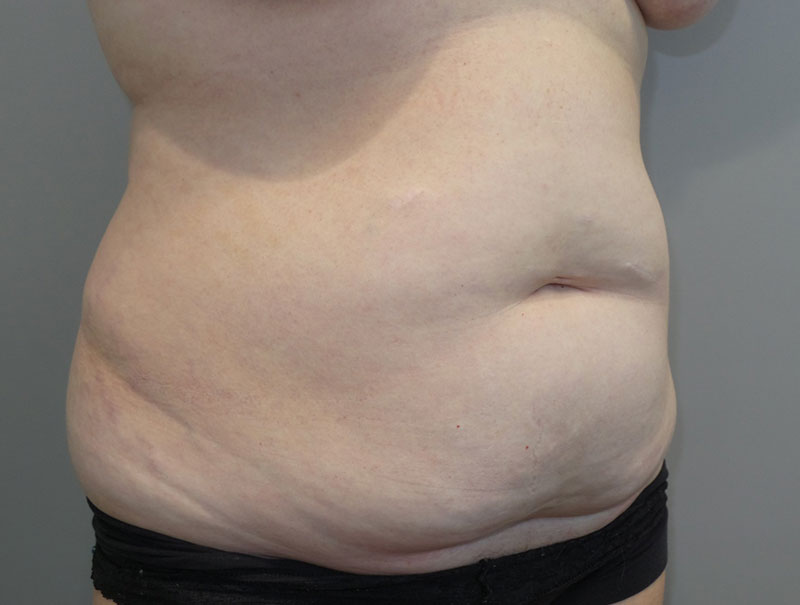 Tummy Tuck Before and After 14 | Grover Aesthetics