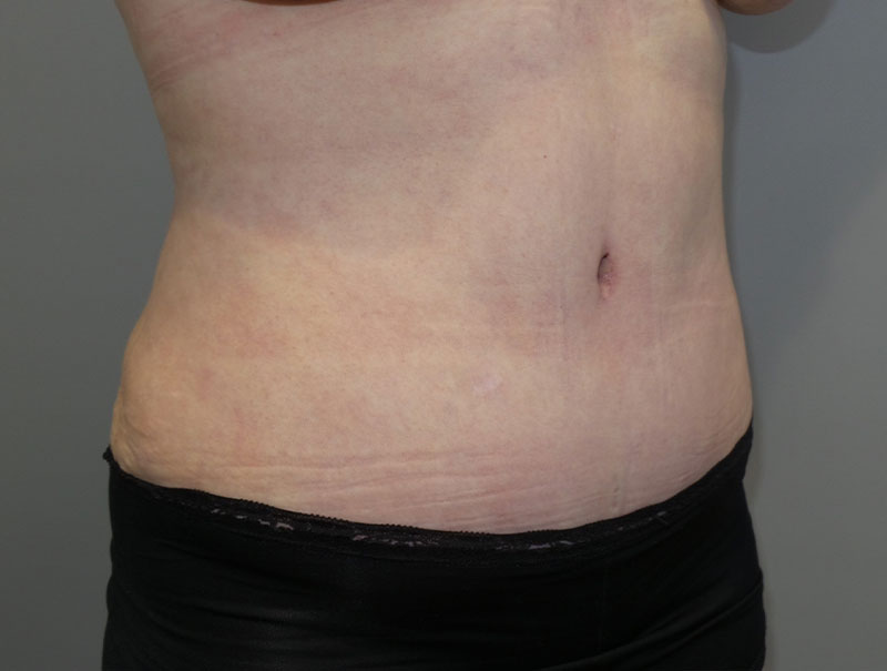 Tummy Tuck Before and After 14 | Sanjay Grover MD FACS