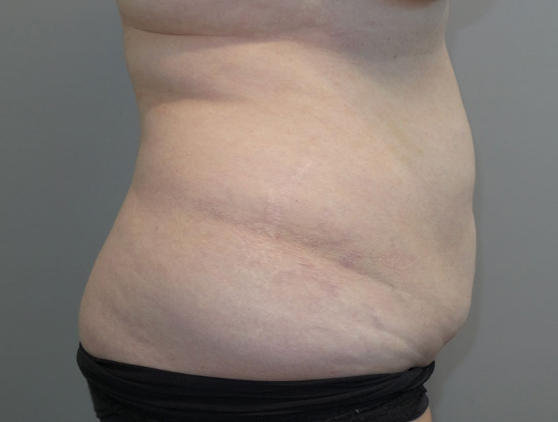 Tummy Tuck Before and After 14 | Sanjay Grover MD FACS