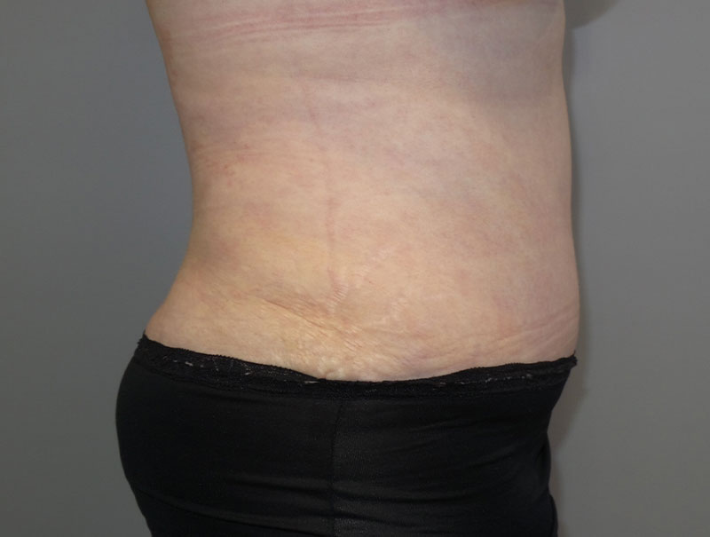 Tummy Tuck Before and After 14 | Sanjay Grover MD FACS