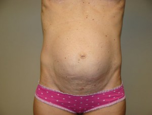 Tummy Tuck Before and After 91 | Sanjay Grover MD FACS