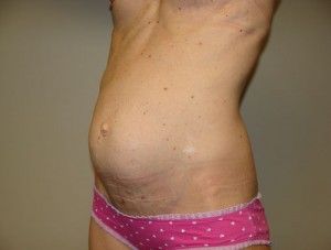 Tummy Tuck Before and After 15 | Sanjay Grover MD FACS