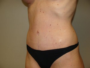 Tummy Tuck Before and After 15 | Sanjay Grover MD FACS