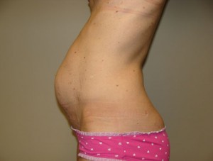 Tummy Tuck Before and After 15 | Sanjay Grover MD FACS