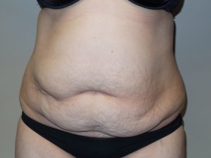 Tummy Tuck Before and After | Grover Aesthetics