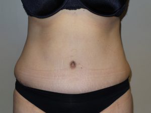 Tummy Tuck Before and After | Grover Aesthetics