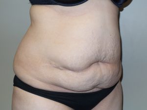 Tummy Tuck Before and After 16 | Sanjay Grover MD FACS