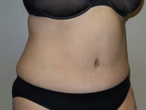 Tummy Tuck Before and After 16 | Grover Aesthetics