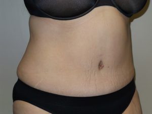 Tummy Tuck Before and After 16 | Sanjay Grover MD FACS