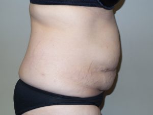 Tummy Tuck Before and After 16 | Sanjay Grover MD FACS