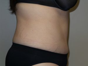 Tummy Tuck Before and After 16 | Sanjay Grover MD FACS