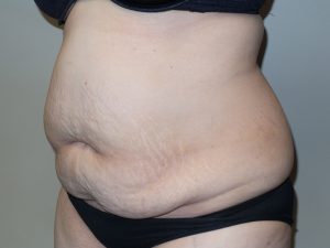 Tummy Tuck Before and After 16 | Grover Aesthetics