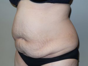 Tummy Tuck Before and After 16 | Sanjay Grover MD FACS