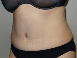 Tummy Tuck Before and After 16 | Sanjay Grover MD FACS