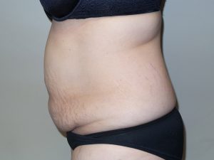 Tummy Tuck Before and After 16 | Sanjay Grover MD FACS