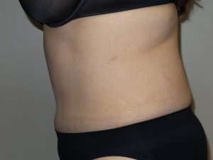 Tummy Tuck Before and After 16 | Sanjay Grover MD FACS