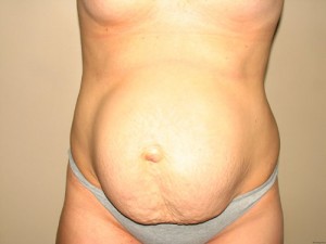 Tummy Tuck Before and After 104 | Sanjay Grover MD FACS