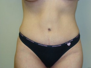 Tummy Tuck Before and After | Grover Aesthetics
