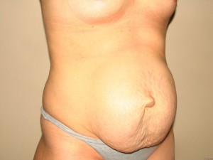 Tummy Tuck Before and After 17 | Grover Aesthetics