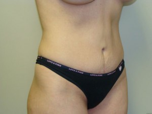 Tummy Tuck Before and After 17 | Sanjay Grover MD FACS