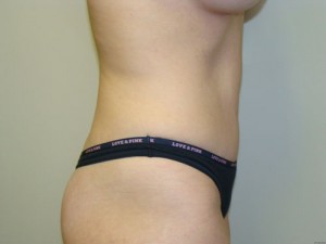 Tummy Tuck Before and After 17 | Grover Aesthetics
