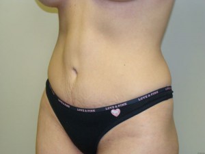 Tummy Tuck Before and After 17 | Grover Aesthetics