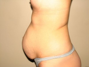 Tummy Tuck Before and After 17 | Sanjay Grover MD FACS