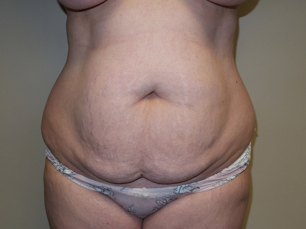 Tummy Tuck Before and After 45 | Sanjay Grover MD FACS