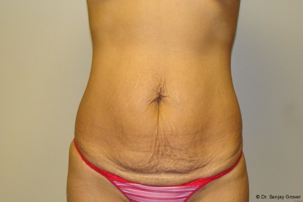 Tummy Tuck Before and After 80 | Sanjay Grover MD FACS