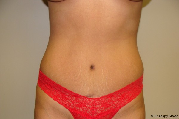 Tummy Tuck Before and After | Grover Aesthetics