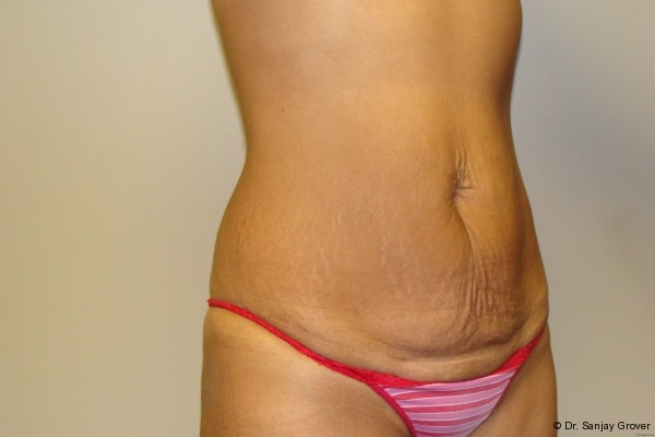 Tummy Tuck Before and After 18 | Sanjay Grover MD FACS