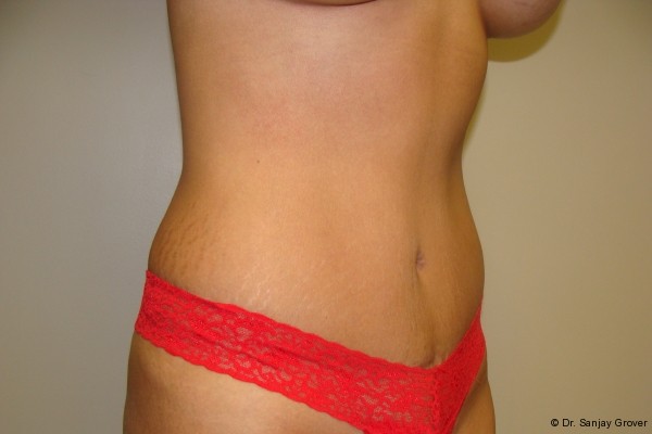 Tummy Tuck Before and After 18 | Sanjay Grover MD FACS