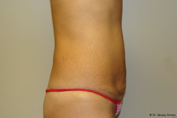 Tummy Tuck Before and After 18 | Sanjay Grover MD FACS