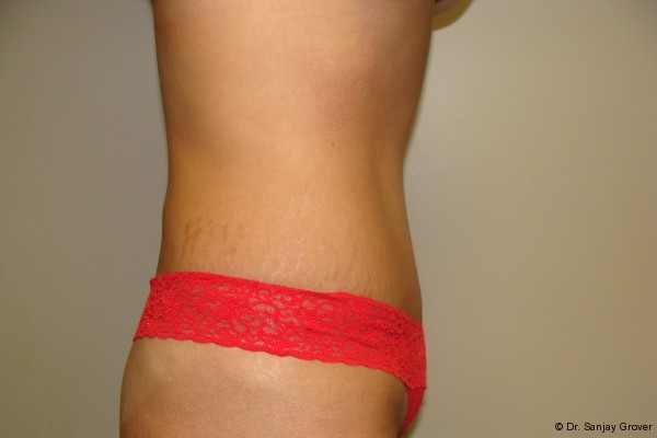 Tummy Tuck Before and After 18 | Grover Aesthetics