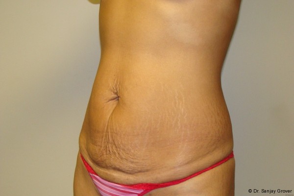 Tummy Tuck Before and After 18 | Grover Aesthetics