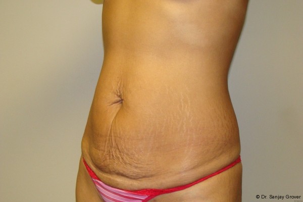 Tummy Tuck Before and After 18 | Sanjay Grover MD FACS