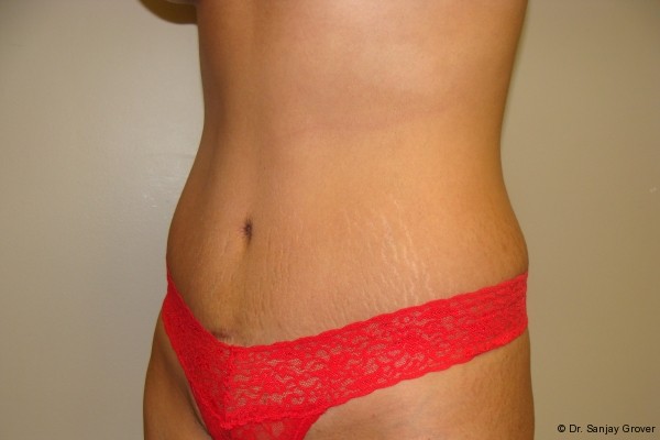 Tummy Tuck Before and After 18 | Sanjay Grover MD FACS