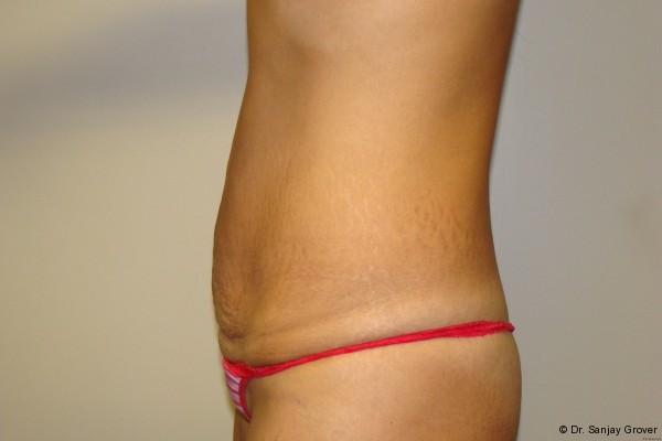 Tummy Tuck Before and After 18 | Sanjay Grover MD FACS