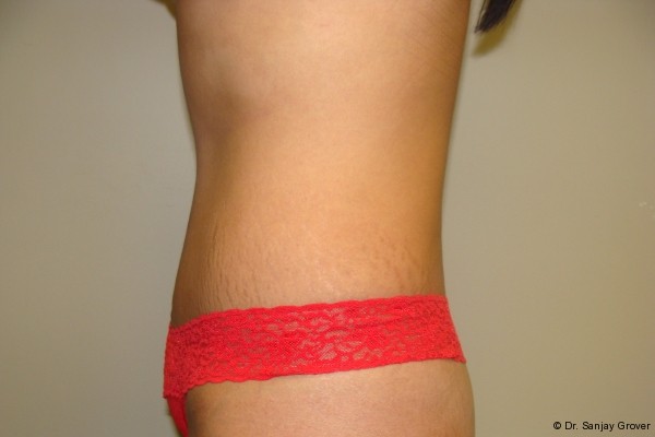 Tummy Tuck Before and After 18 | Grover Aesthetics