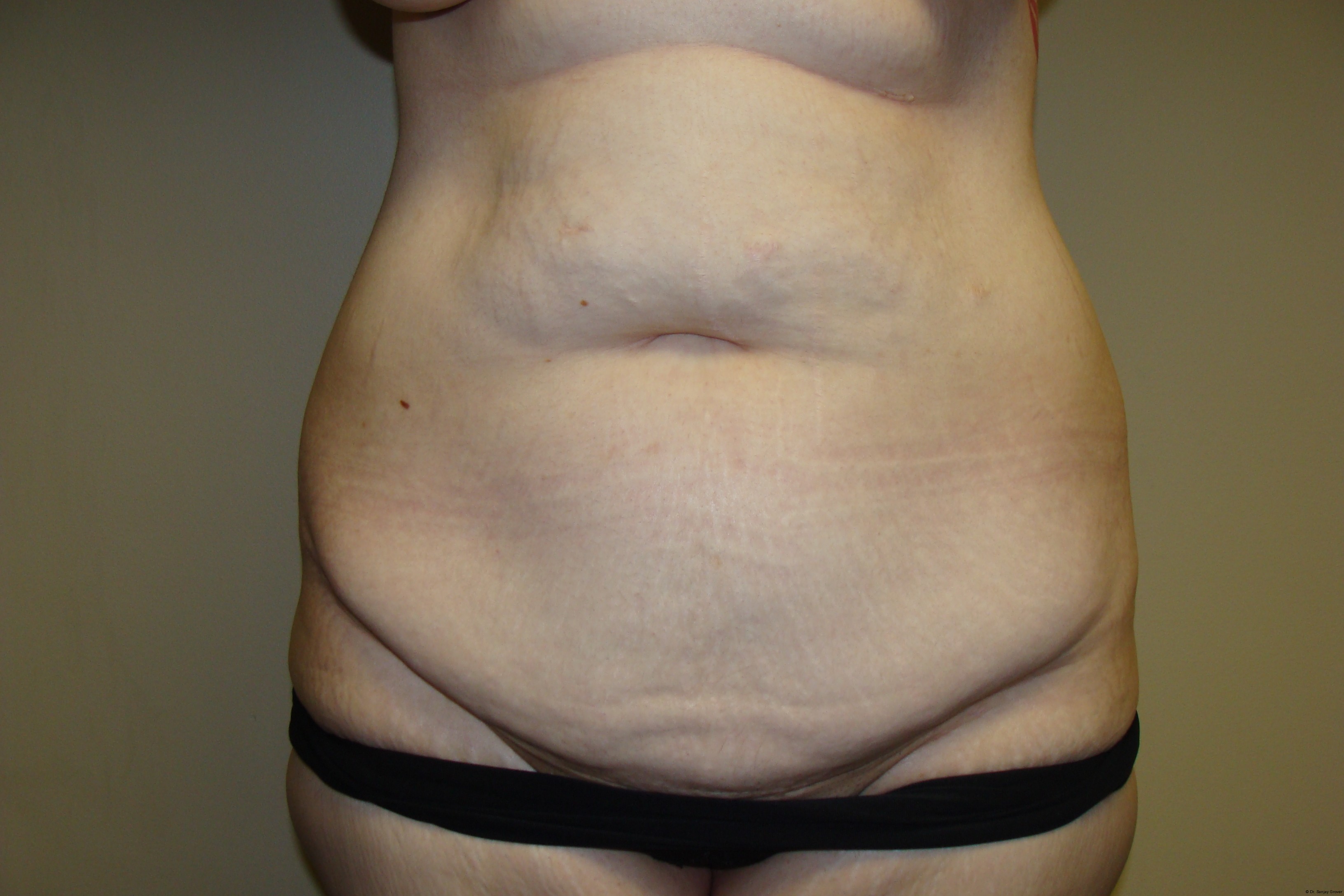 Tummy Tuck Before and After 80 | Sanjay Grover MD FACS