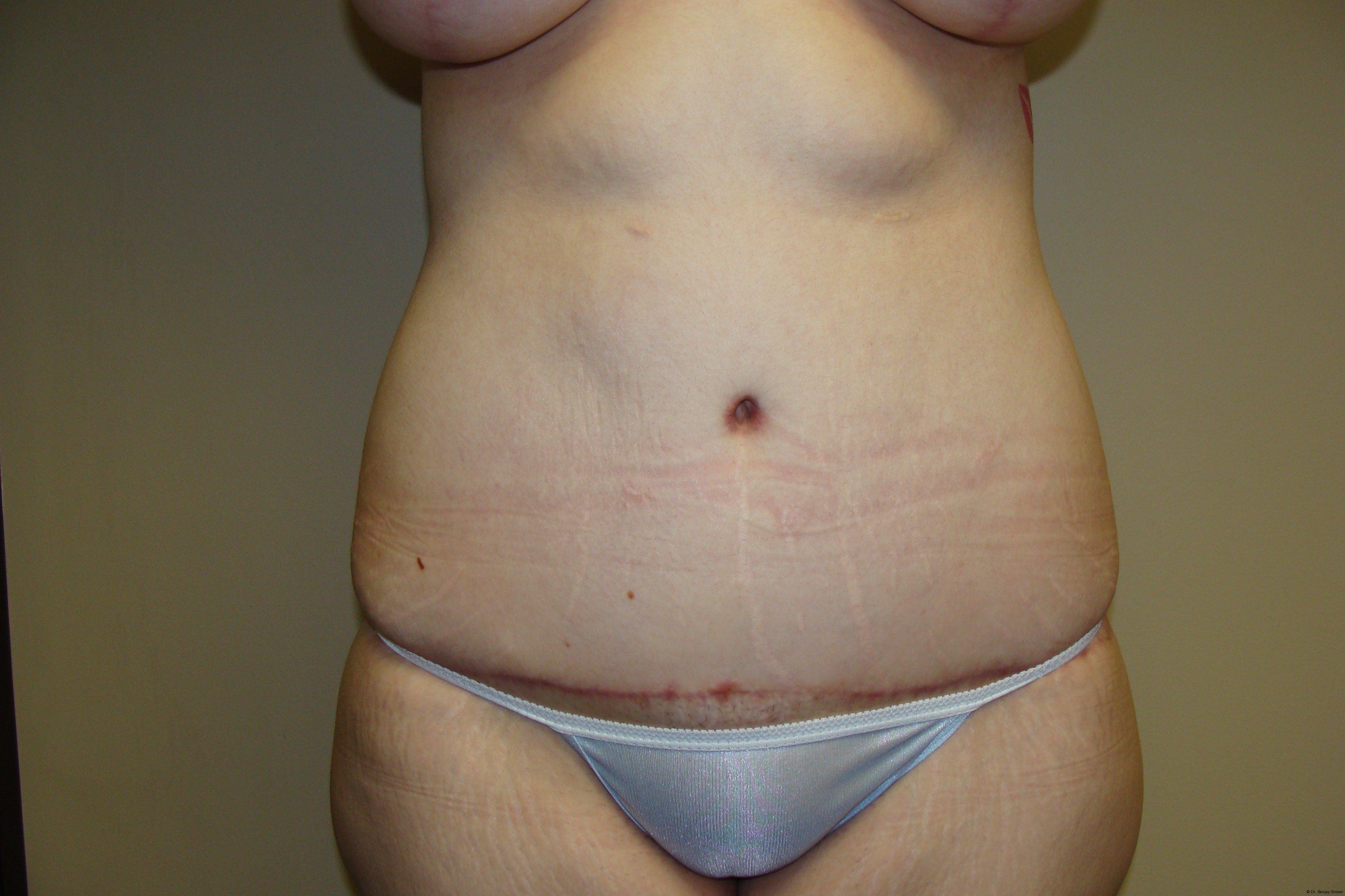 Tummy Tuck Before and After | Grover Aesthetics