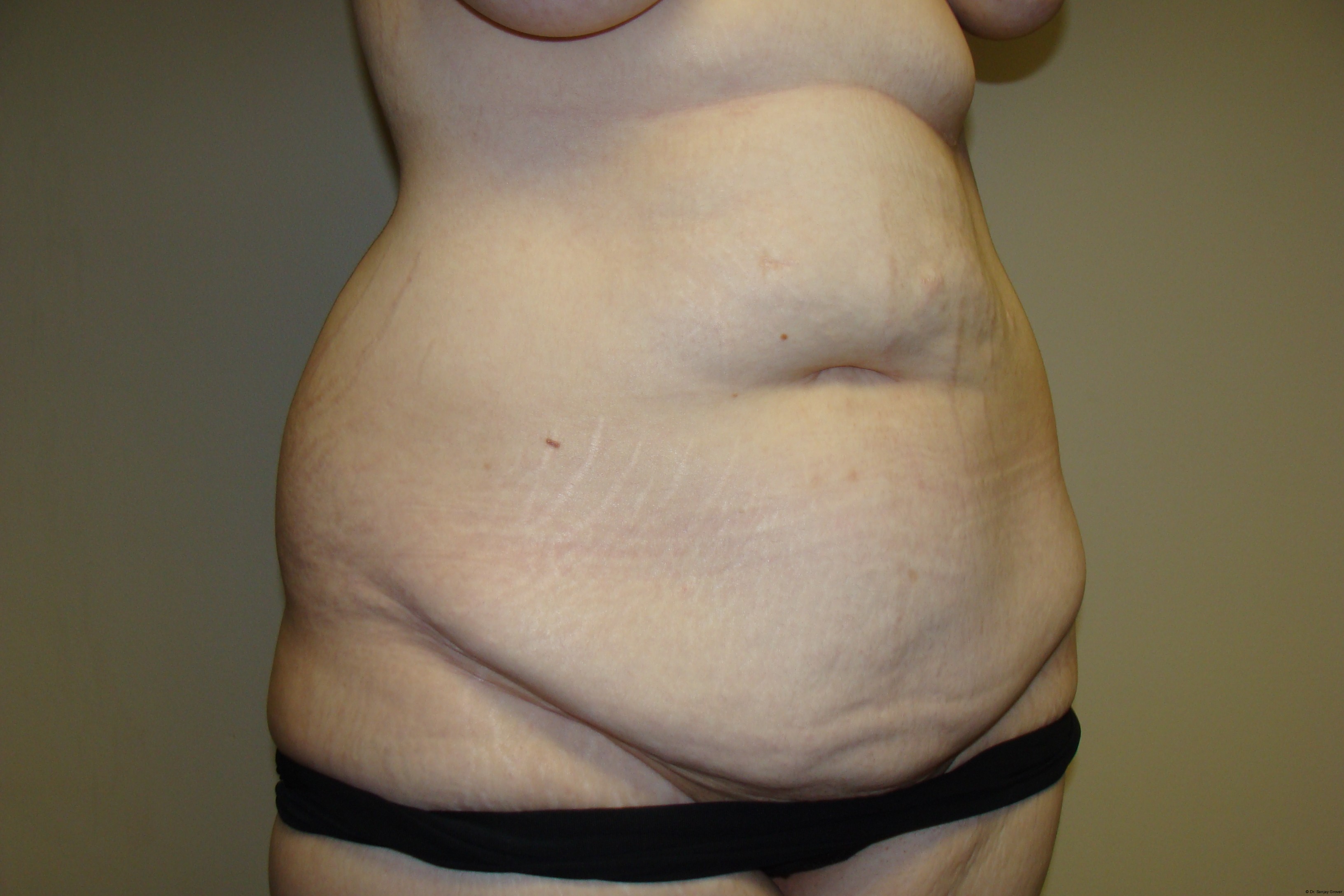 Tummy Tuck Before and After 19 | Sanjay Grover MD FACS