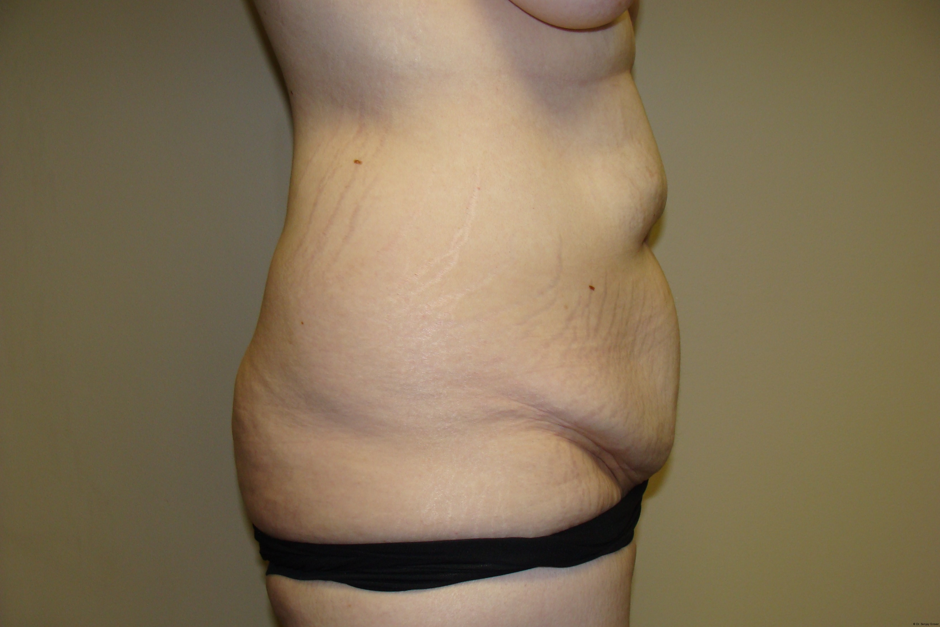 Tummy Tuck Before and After 19 | Grover Aesthetics