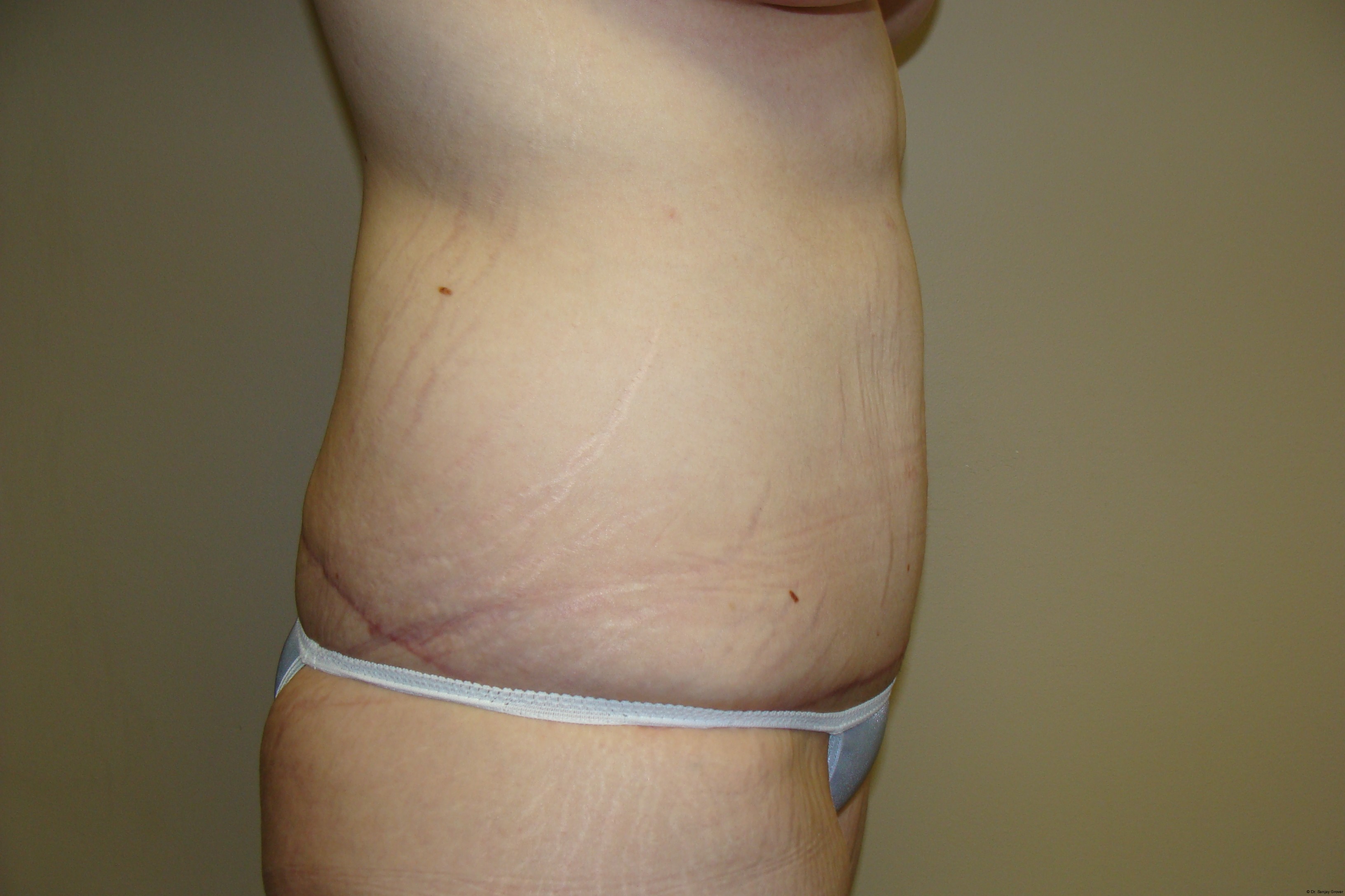 Tummy Tuck Before and After 19 | Sanjay Grover MD FACS