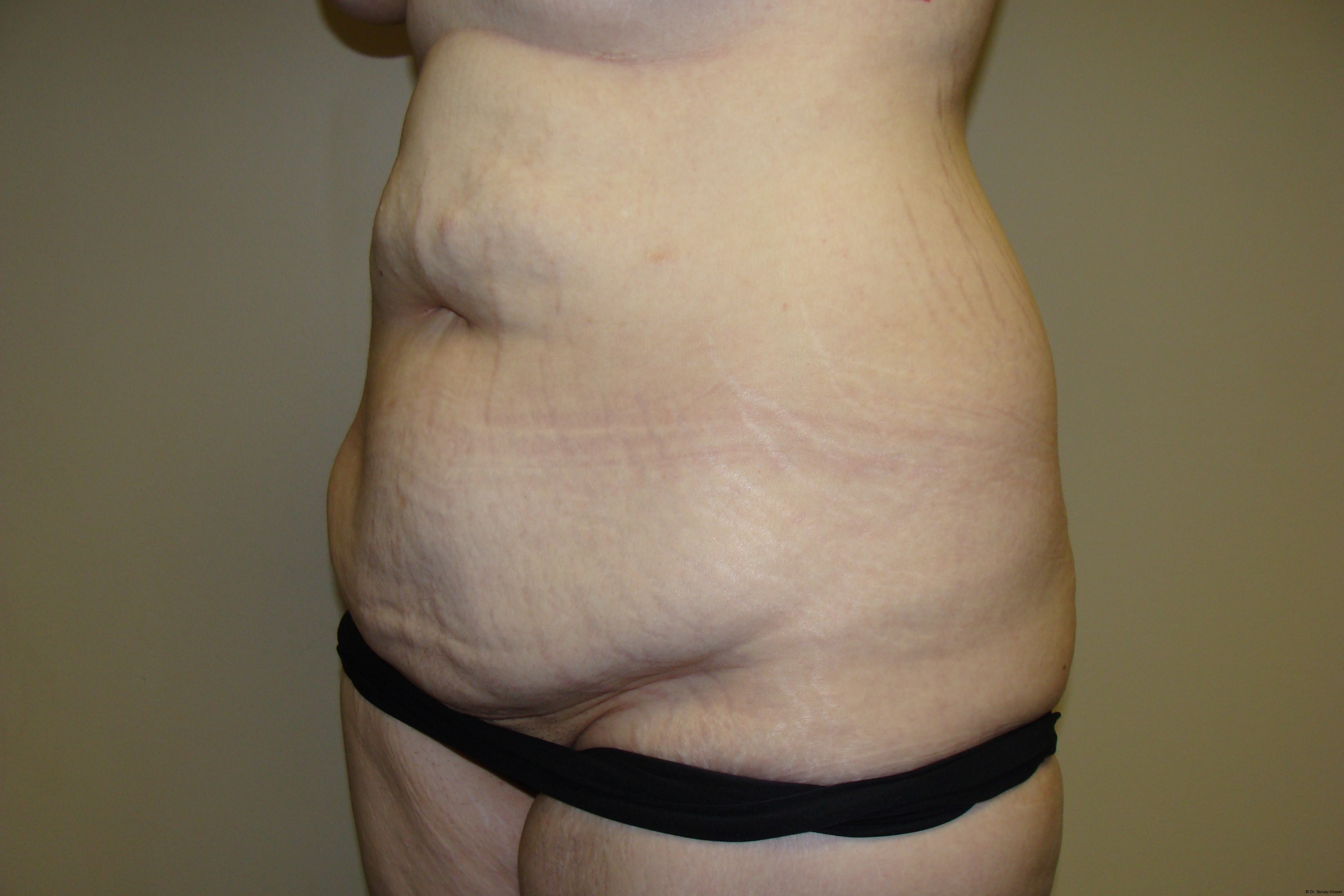Tummy Tuck Before and After 19 | Grover Aesthetics