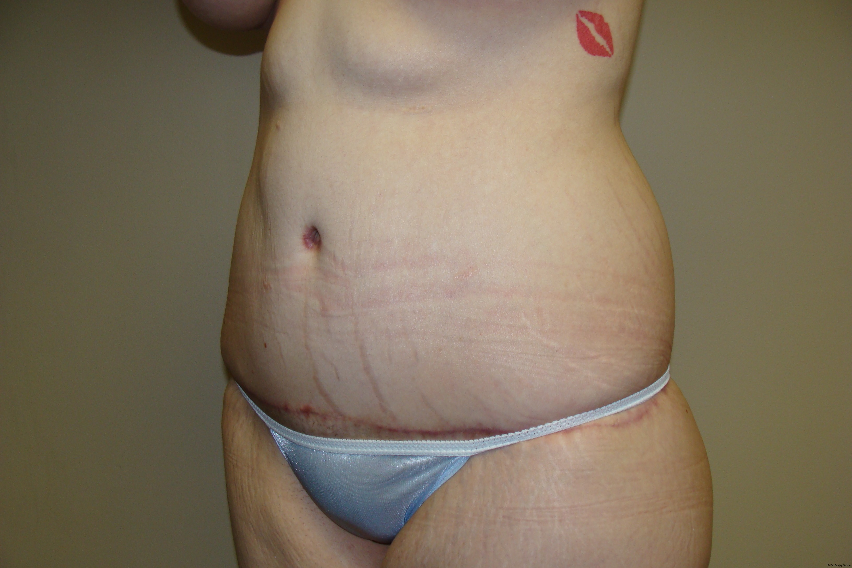 Tummy Tuck Before and After 19 | Grover Aesthetics