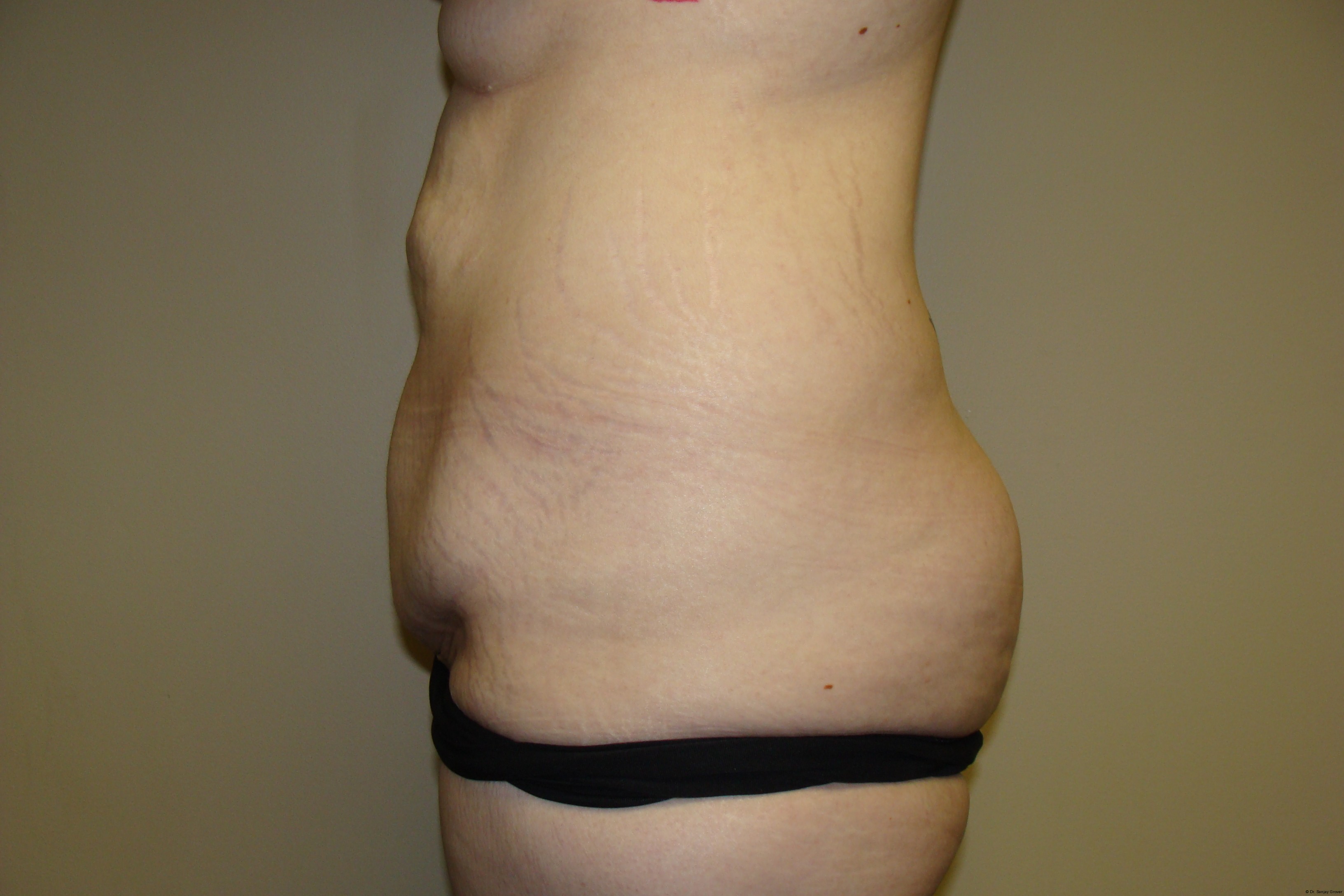 Tummy Tuck Before and After 19 | Grover Aesthetics