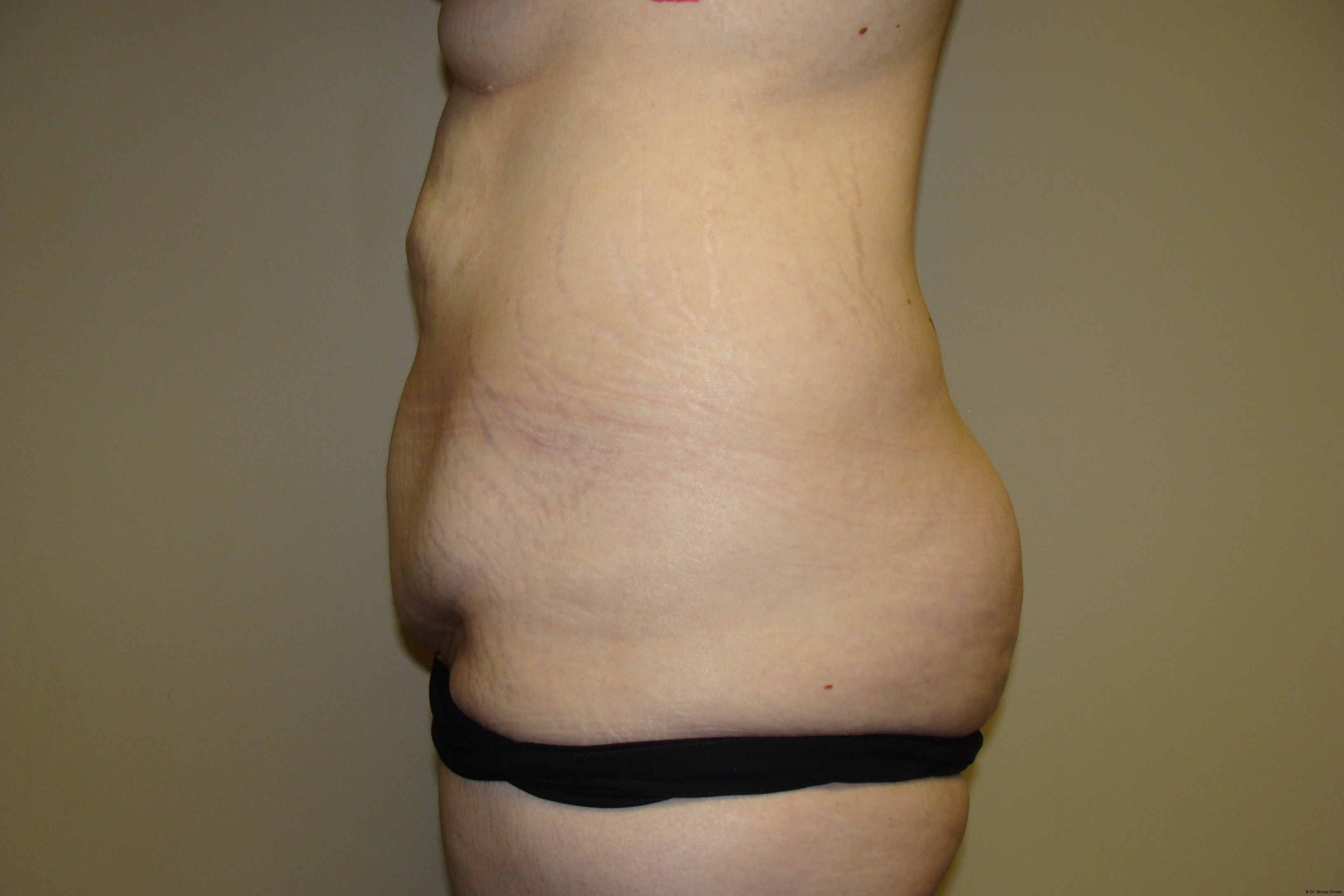 Tummy Tuck Before and After 19 | Sanjay Grover MD FACS